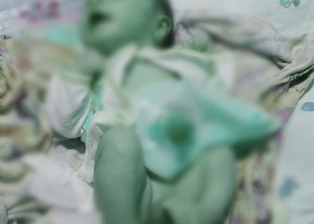 Memperihatinkan: Bayi Di Manggarai Lahir Tanpa Anus