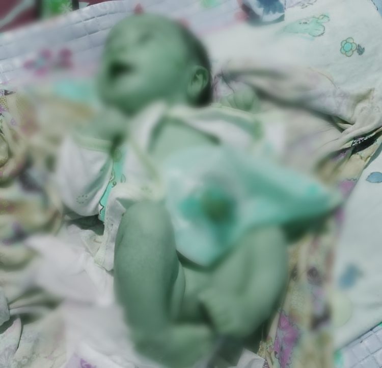 Memperihatinkan: Bayi Di Manggarai Lahir Tanpa Anus