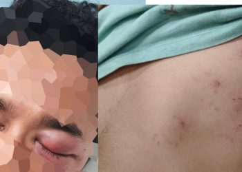 Dua Karyawan Resort Diduga Dikeroyok OTK di Mbarata, Korban Tempuh Jalur Hukum