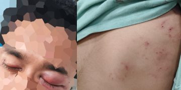 Dua Karyawan Resort Diduga Dikeroyok OTK di Mbarata, Korban Tempuh Jalur Hukum